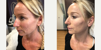 Dermal Fillers before and after photo