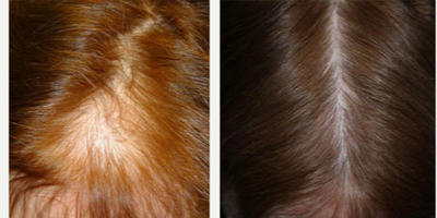 FUE Hair Transplant before and after photo