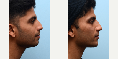 Botox before and after photo