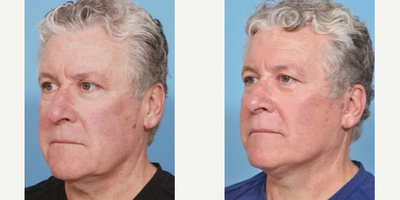 Facelift before and after photo