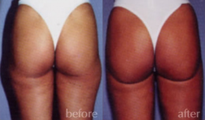 Liposuction before and after photo