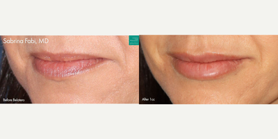 Belotero before and after photo