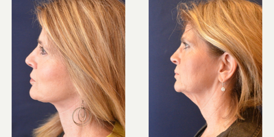 Facelift before and after photo