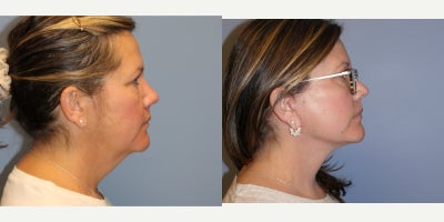 Facelift before and after photo