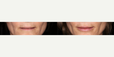 Juvederm before and after photo