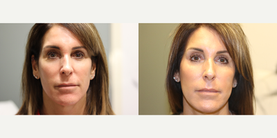 Nonsurgical Facelift before and after photo
