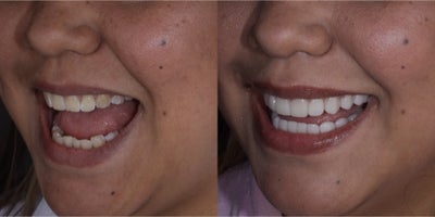 Porcelain Veneers before and after photo