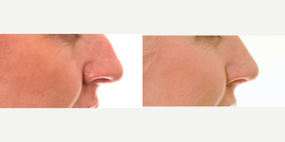 Septoplasty before and after photo