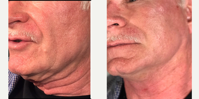 Thread Lift before and after photo