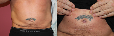 Belly Button Surgery before and after photo