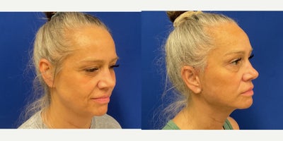 Facial Fat Transfer before and after photo