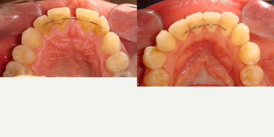 Invisalign before and after photo