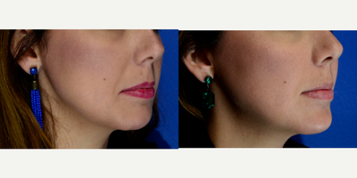 Juvederm before and after photo