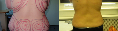 Liposuction before and after photo