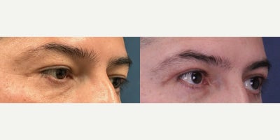 Rhinoplasty before and after photo