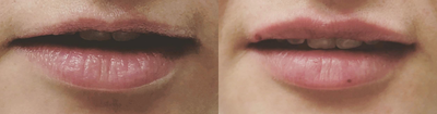 Dermal Fillers before and after photo