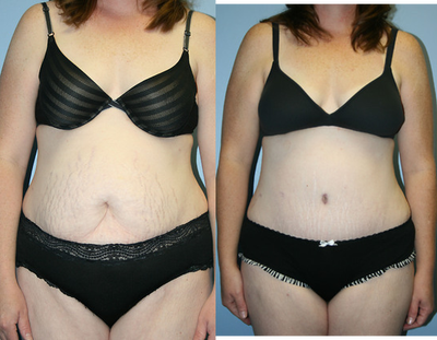 Tummy Tuck before and after photo