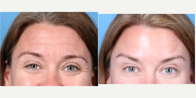 Botox before and after photo