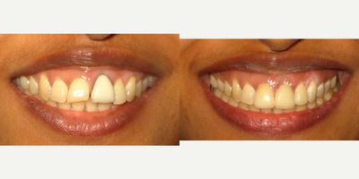 Dental Crown before and after photo