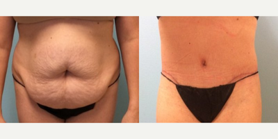 Tummy Tuck before and after photo