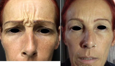 Botox before and after photo