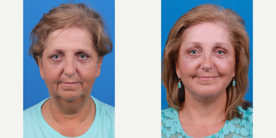 Brow Lift before and after photo
