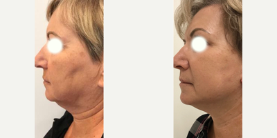 Facelift before and after photo