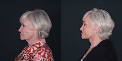 Neck Lift before and after photo