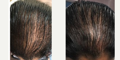 PRP for Hair Loss before and after photo