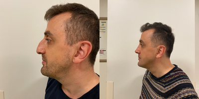 Septoplasty before and after photo