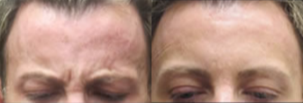 Botox before and after photo