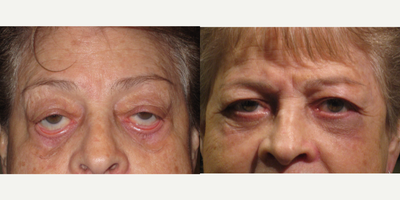 Eyelid Retraction Repair before and after photo