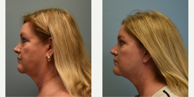 Eyelid Surgery before and after photo