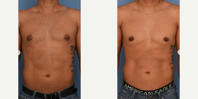 Gynecomastia Surgery before and after photo