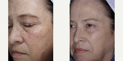 Halo Laser before and after photo