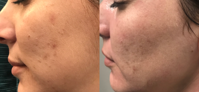Halo Laser before and after photo