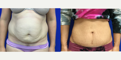 Tummy Tuck before and after photo