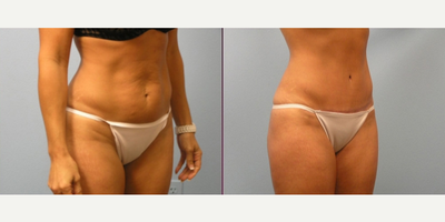 Tummy Tuck before and after photo