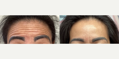 Botox before and after photo