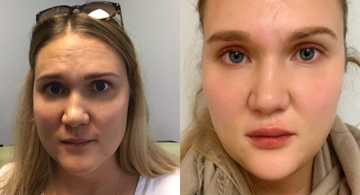 Lip Fillers before and after photo