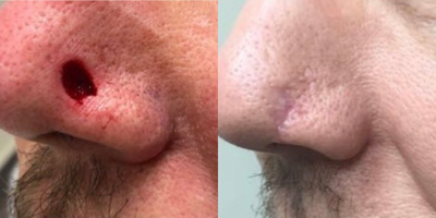 Mohs Surgery before and after photo