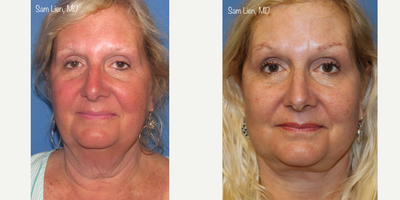 Neck Lift before and after photo