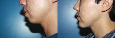 Chin Implant before and after photo