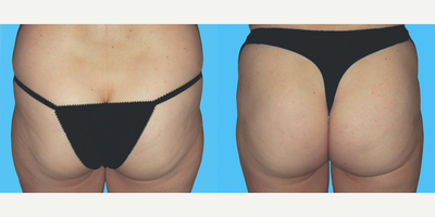 Liposuction before and after photo