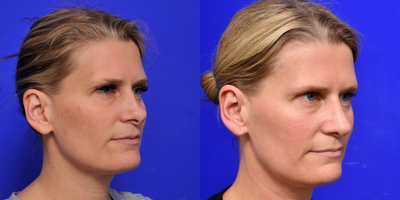 Revision Rhinoplasty before and after photo