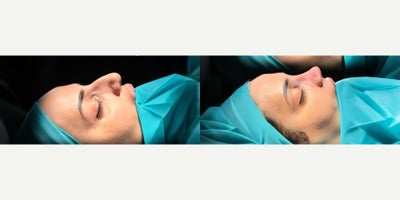 Rhinoplasty before and after photo