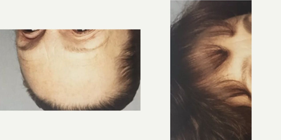 Skin Rejuvenation before and after photo