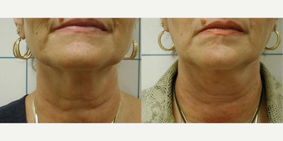Smart Lipo before and after photo