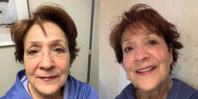 Chemical Peel before and after photo