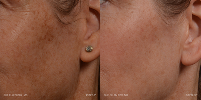Clear and Brilliant before and after photo